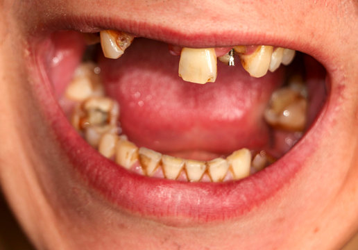 open mouth with broken, diseased teeth affected by caries and periodontitis. Steel pin in the gum for the installation of a dental crown. Smoker's teeth coated with nicotine plaque.