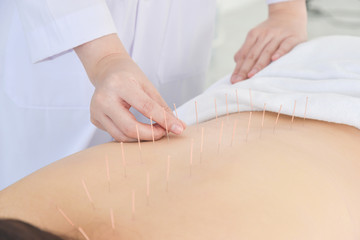Obraz na płótnie Canvas Hands of therapist doing acupuncture at patient back ,Alternative medicine concept.