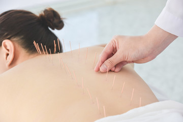 Close up of hands doing acupuncture with at patient back ,Alternative medicine concept. - obrazy, fototapety, plakaty