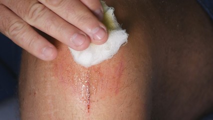 Doctor Applying a Sterile Bandage with Antibiotics on a Leg Wound in Hospital, Treatment on a Surgical Incision on a Knee