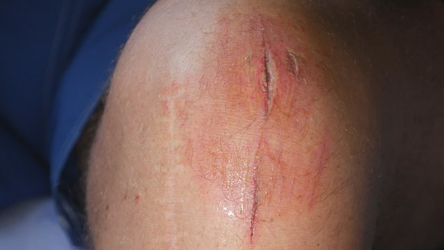 Image with a Leg Wound a Bleeding Scar a Painful Scratch from an Accident, a Man Suffering Waiting in Hospital Emergency Nursing