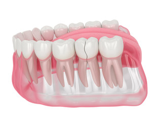 3d render of jaw with cracked tooth