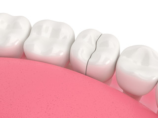 3d render of jaw with cracked tooth