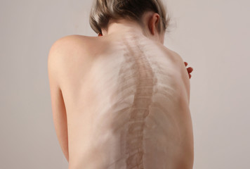 Back pain, female Scoliosis Spine curve Anatomy,