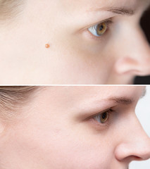 Laser or electro coagulation treatment for mole removal before and after close-up