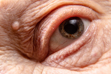 The blue eye of an old man with many brown specks on the iris.