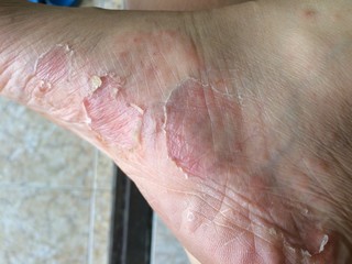 Fototapeta premium Peeling skin, rash on the feet, must be treated with medicine.