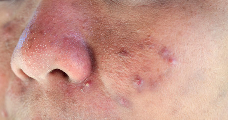 Fototapeta premium Acne on facial skin,Dermatological disease acne