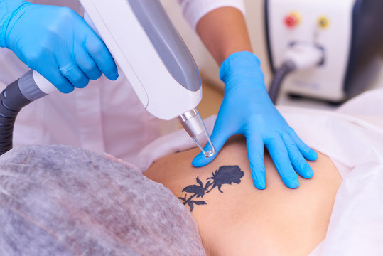Laser tattoo removal in a cosmetology clinic.