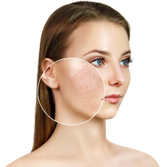 Young woman with zoom circle shows dry facial skin.