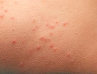Obraz na płótnie Canvas allergic rash on children's skin