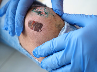 The doctor examines the healing wound of the patient on the leg of the knee torn jeans scarring