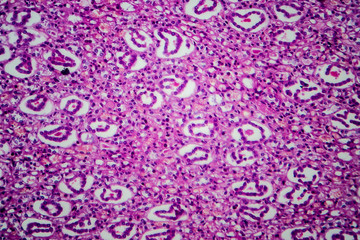 Acute pyelonephritis, light micrograph