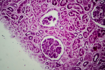Diffuse proliferative glomerulonephritis