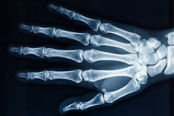 Human adult female right hand bones x-ray image. Medical and anatomy radiography or imagery. - obrazy, fototapety, plakaty