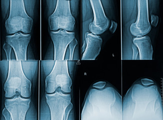Adult male knees x-ray image with different angles. Medical and human anatomy imagery.