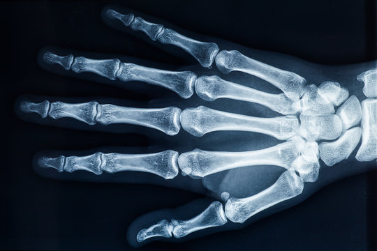 Human adult female right hand bones x-ray image. Medical and anatomy radiography or imagery.