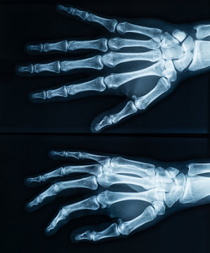 Human female adult right hand skeleton x-ray image. Medical and anatomy imagery.