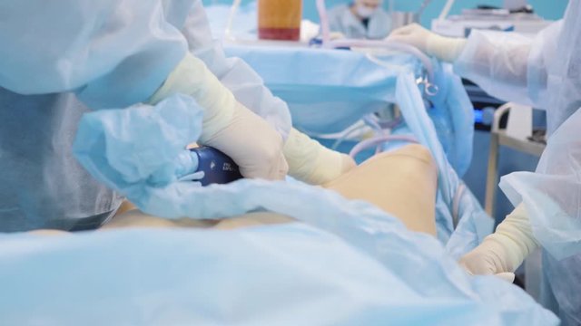 The surgeon performs an operation with an assistant close-up of the abdomen Liposuction, lipomodelling
