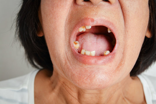 An elderly Asian woman smiled and saw the remaining teeth in the mouth. Due to partial loss resulting in the need to wear artificial teeth. The concept of good oral health
