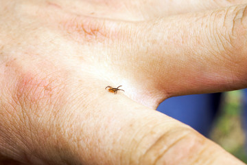 Fototapeta premium Hard mite, scale tick of family Ixodidae on human hand. Carrier of pathogens that can cause human disease