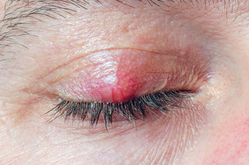 Obraz premium Chalazion on the eyelid of a man close-up