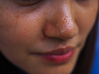 Wrinkles, acne on a woman's nose    