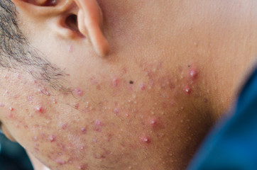 Fototapeta premium Inflammatory acne