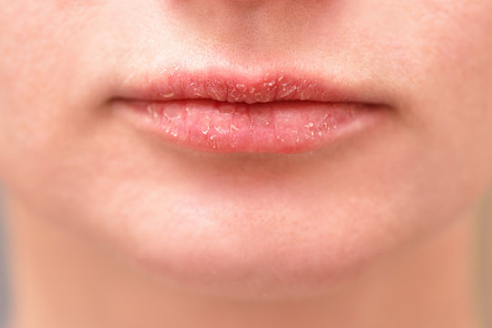 close-up of weathered female lips with dry skin. Health and skin care concept.