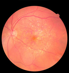 Medical photo retina diabetic retinopathy. Examination of the eye, diabetic retinopathy, ARMD