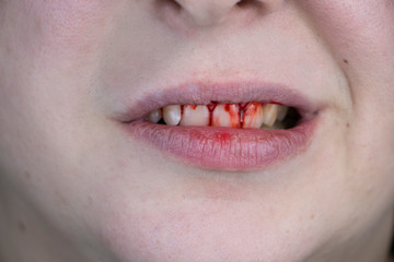 The man has blood on his teeth, severe bleeding of the gums after a blow to the jaw. Close-up of...