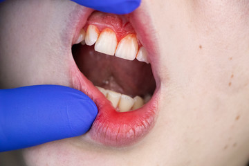 Gum bleeding and inflammation close up. A man examined by a dentist. The diagnosis of gingivitis