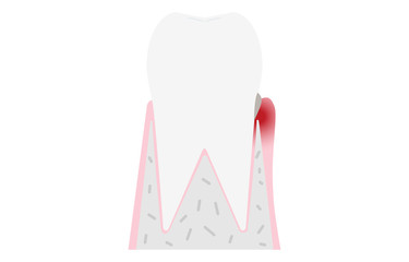 歯周病の進行段階別イラスト：歯肉炎