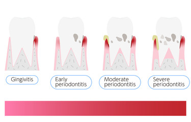 歯周病の進行段階別イラスト：進行順