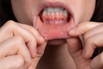 Obraz premium gum problems in pregnant women: how to relieve symptoms