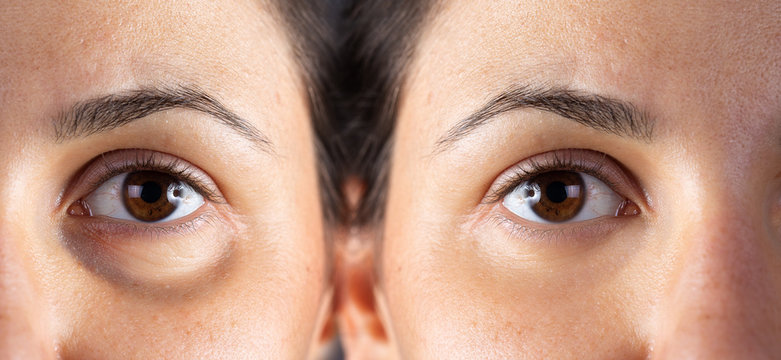 lower blepharoplasty: before and after treatment