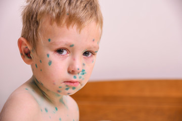 Young toddler,boy with chickenpox. Sick child with chickenpox. Varicella virus or Chickenpox bubble rash on child body and face.