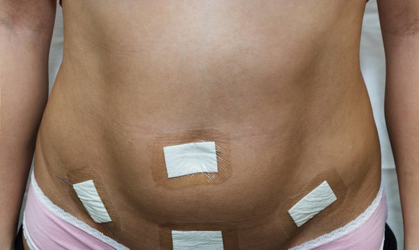 Belly of a young woman after laparoscopy surgery. White background. The abdomen is sealed with a patch after surgery to remove the ovarian cyst by laparoscopy in a clinic. Dressings for laparoscopic w