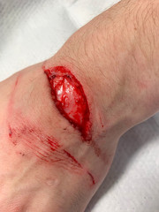 Injury from a cut on the wrist and hand requiring stitches in the Emergency room