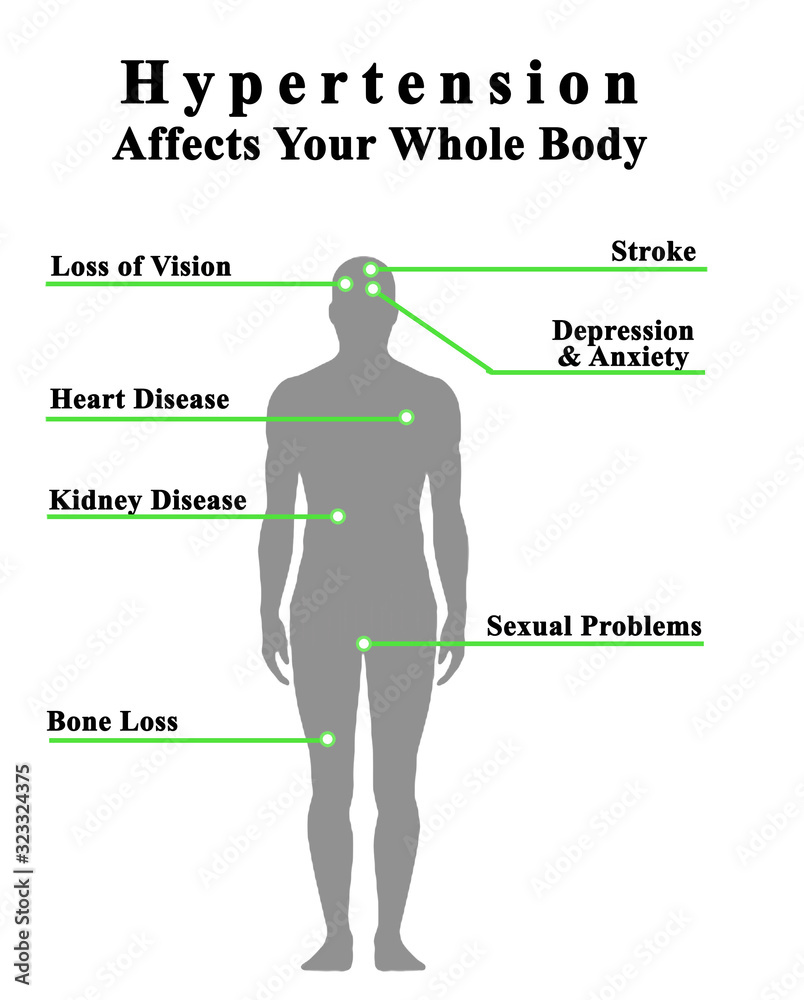 Wall mural Hypertension Affects Your Whole Body