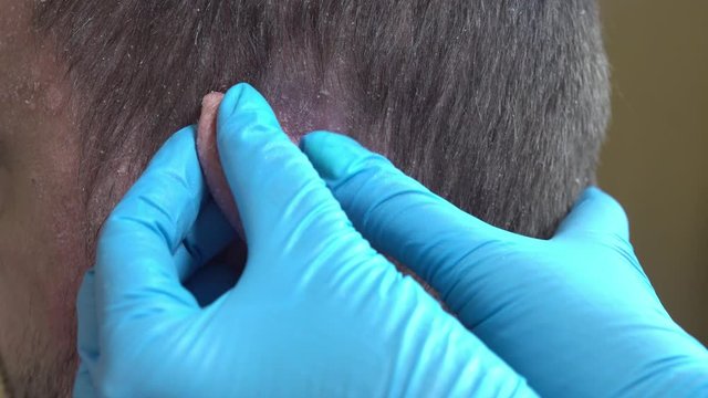  examined by a doctor. psoriasis