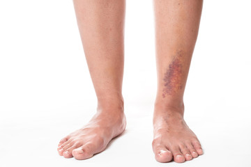 Asian women have bruise on leg from accident on white background.
