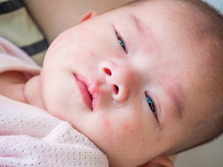 newborn baby with allergy on face