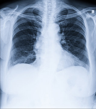 Chest x-ray - lungs, heart, ribs, clavicle. Medicine and Health