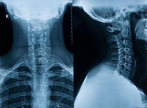 X-ray picture of the cervical spine of a man in two projections in full view and profile