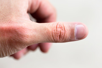 Finger pain with severe gout in men.