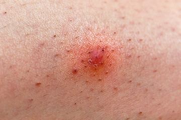 Closeup of caucasian skin with ingrown hair