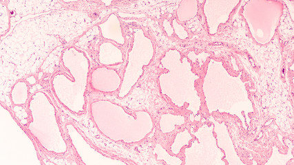 Photomicrograph of a cavernous lymphangioma (cystic hygroma) excised from the neck of a child.   These benign lesions are often present at birth and involve blockage of lymphatic system. 