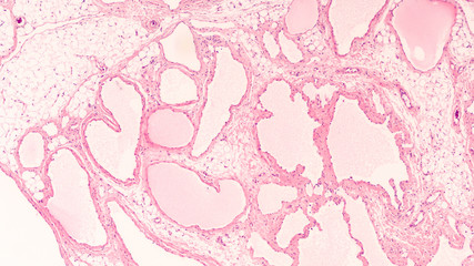 Photomicrograph of a cavernous lymphangioma (cystic hygroma) excised from the neck of a child.  ...