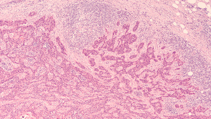 Metastatic squamous cell carcinoma involving a cervical (neck) lymph node. The primary site is likely mouth or throat (oropharyngeal).  Alcohol and tobacco increase risk, as does HPV virus.